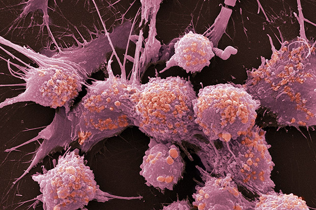 Prostate cancer cells