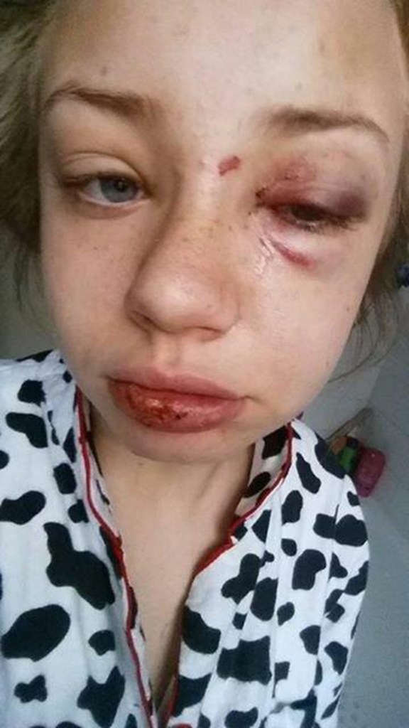  Sara Dudek, 17, was assaulted so fiercely by boyfriend Kane Case-Webb, 20, that her contact lens shot behind her eye and left it pouring with blood