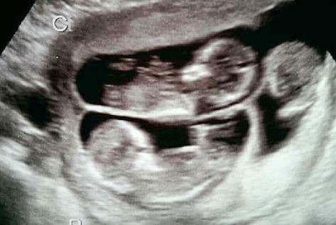 Ultrasound of the triplets