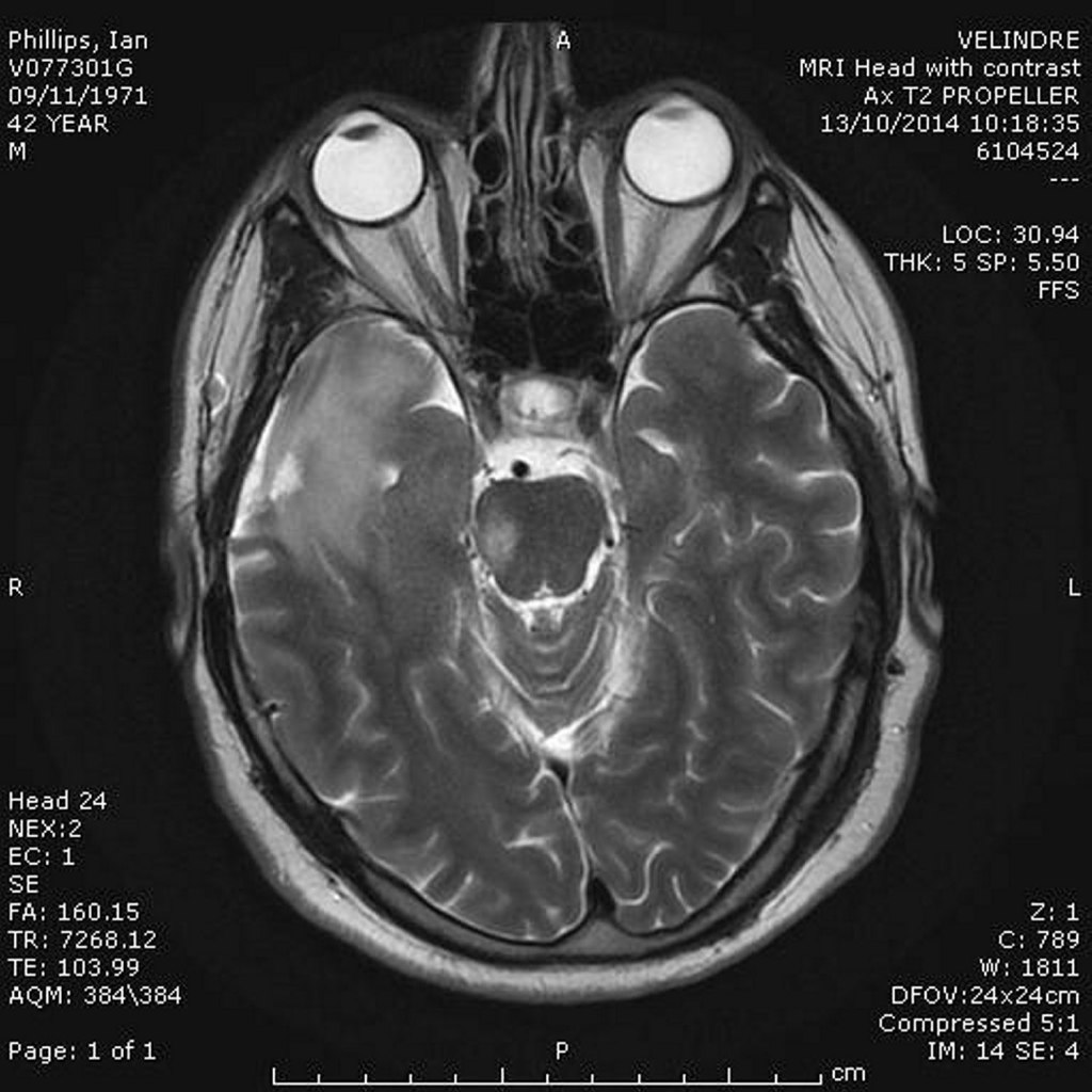  A tumour the size of a lemon showed up on one of Ian's own MRI scanners at the University Hospital of Wales, Cardiff