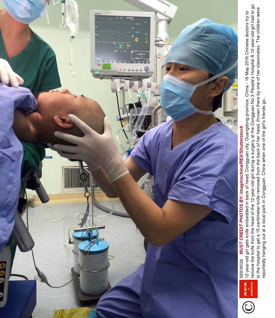  Neurosurgeons in China had to perform emergency surgery on the 12-year-old to remove the blade from her skull