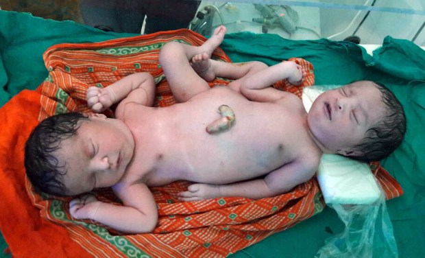 She had no idea she was carrying conjoined twins, despite thorough check-ups before her pregnancy including ultrasounds