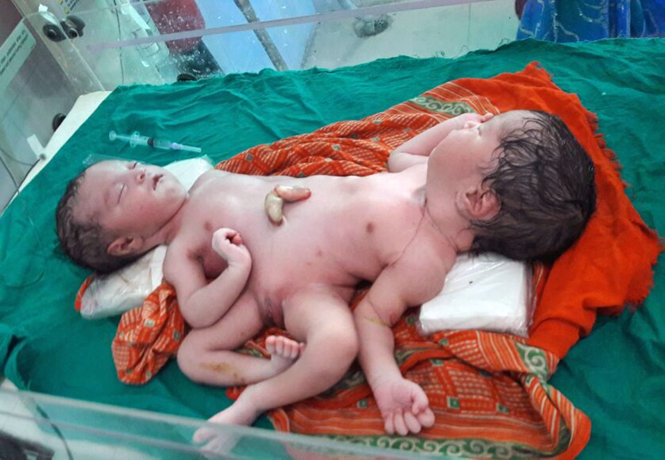  Unable to afford travel or the high cost of medical treatment, the couple were forced to take the babies home