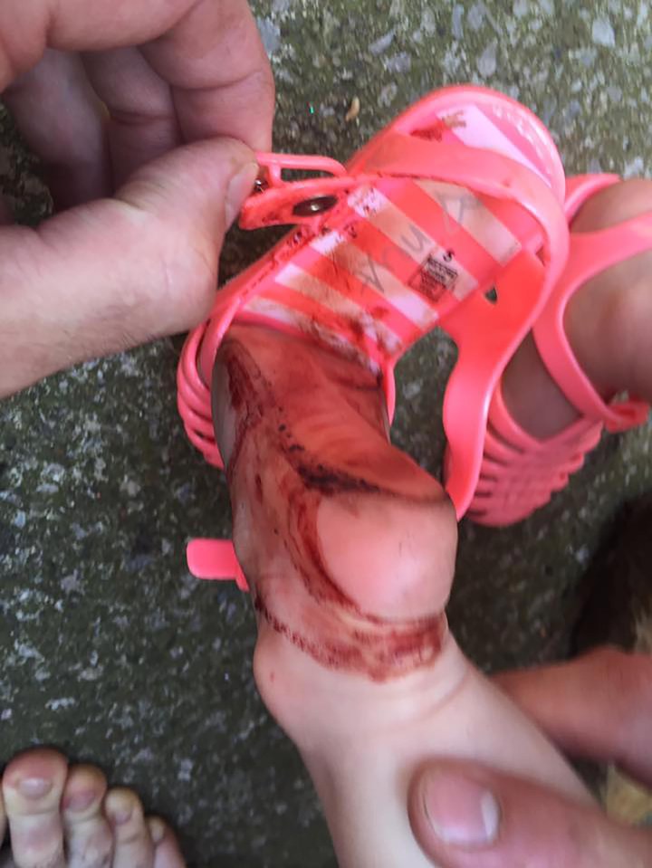  The tot's foot was allegedly left cut and bloody from the jelly shoes