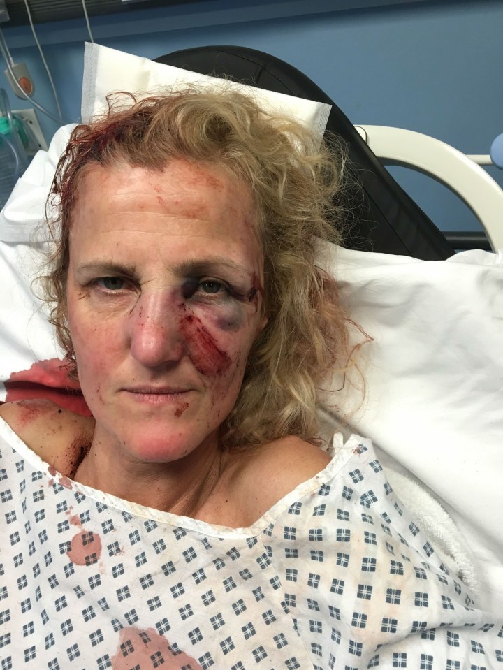  Melanie Robinson suffered two breaks to her nose, a black eye and swollen face