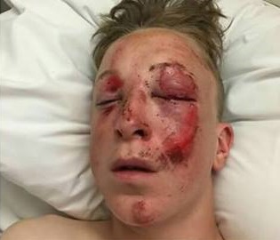  15-year-old Jack Emson suffered a broken leg and wrist in the horror smash