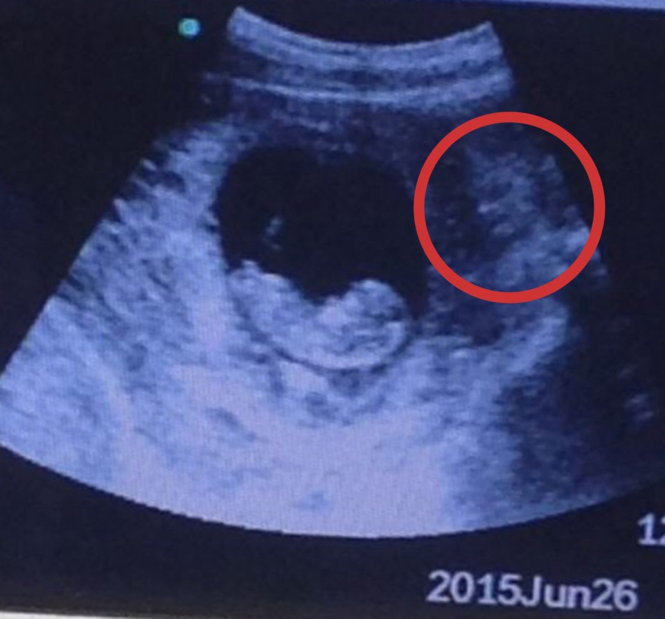  Does this ultrasound show a 'demon' lurking in the womb?