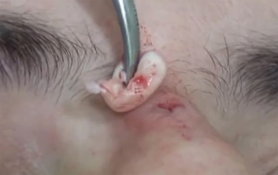  Lots of white pus seeps out of the gash