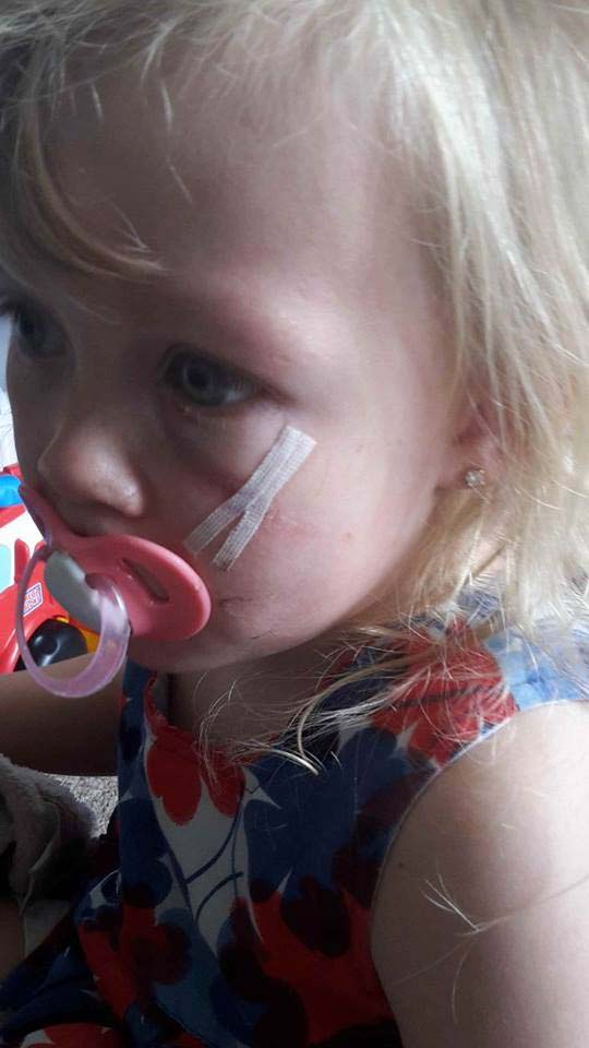 The three-year-old sustained scarring to her face and head in the terrifying crushing 