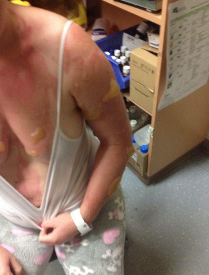  The mum-of-three was left with horrific burns and blisters all over her body