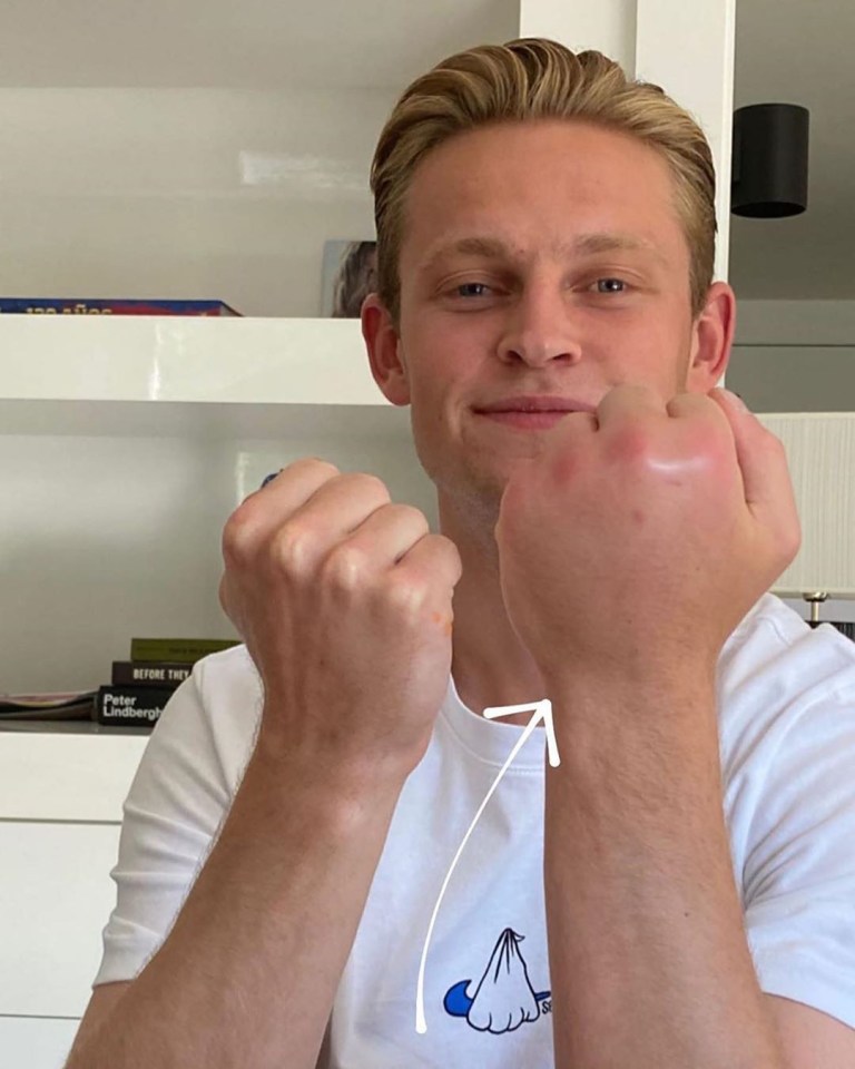  Frenkie De Jong shows off horrific bee sting