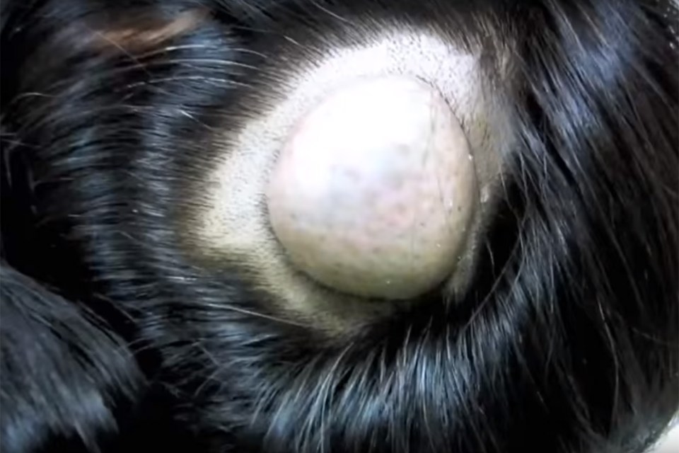  This giant cyst has been growing for a decade