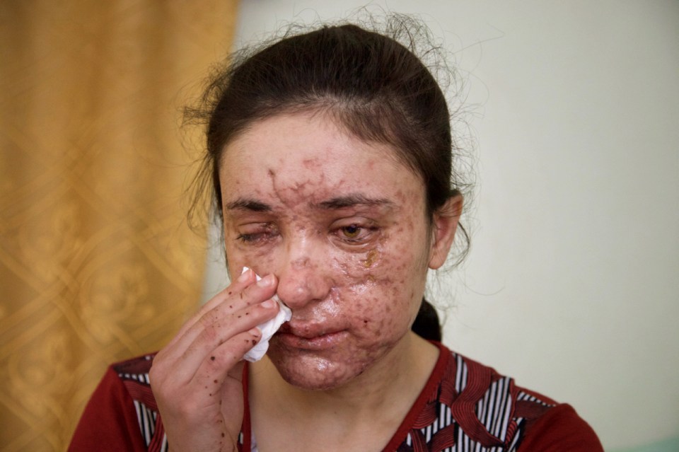  Lamiya Aji Bashar was left permanently scarred when a landmine blew up as she fled her ISIS captors