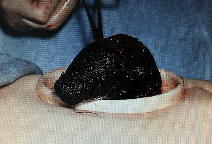 Doctors removed a hairball that measured a foot during a six hour op