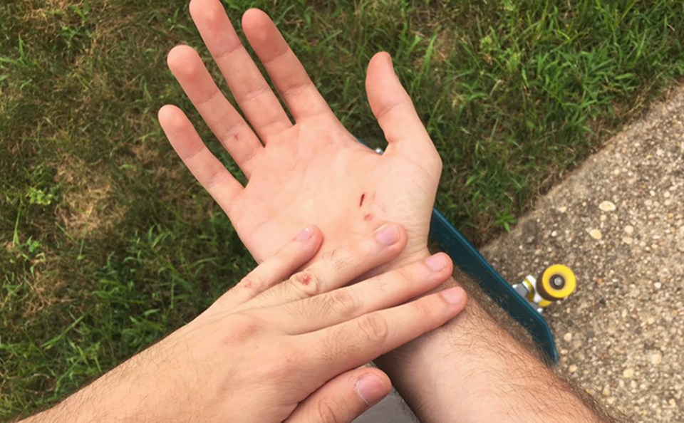 Mike Schultz injured his hand when he fell off his skateboard whilst searching for the virtual creatures 