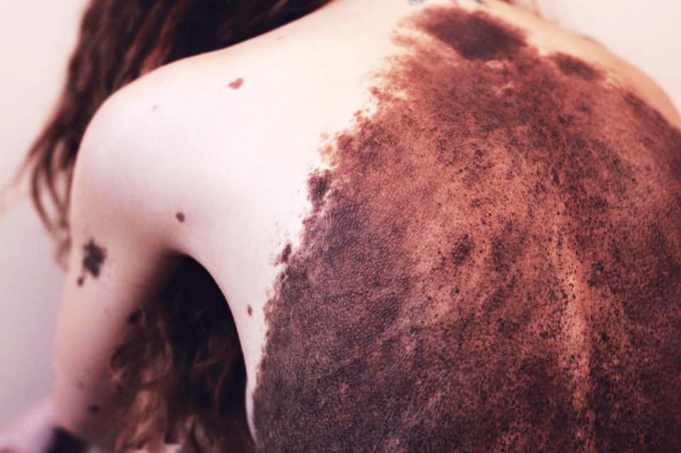  Yulianna's largest birthmark covers most of her back