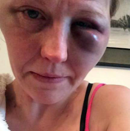  Ashley suffered horrific injuries when her boyfriend flew off the handle in an unprovoked attack