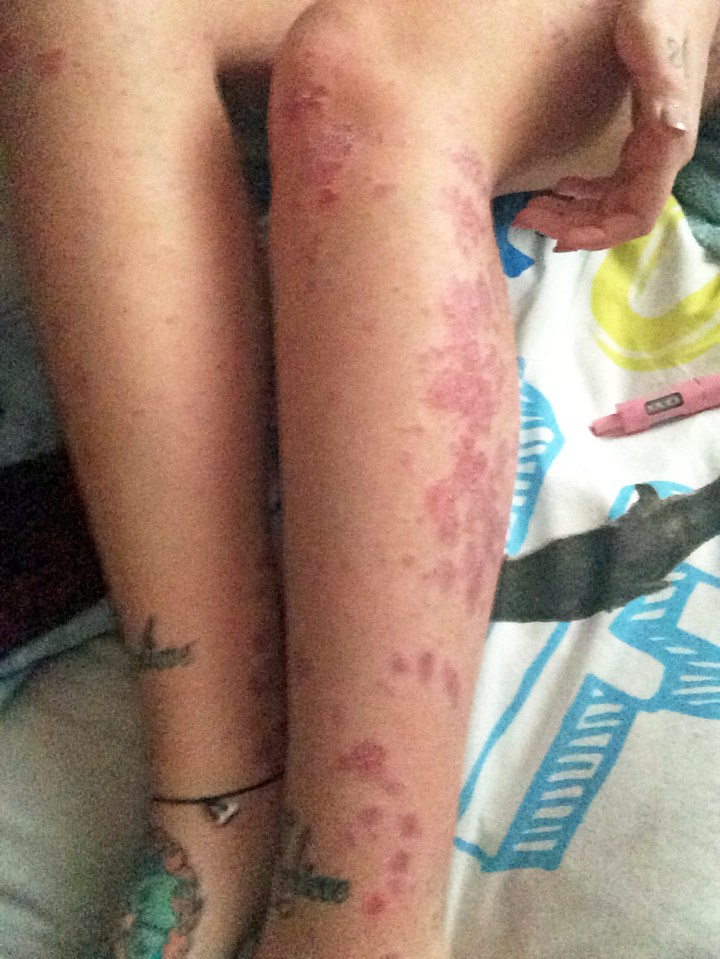 The condition leaves Chloe with snake-like skin