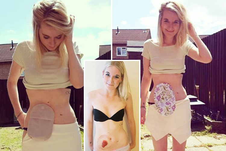  Brave Jade uses an ileostomy bag to manage her chronic bowel condition