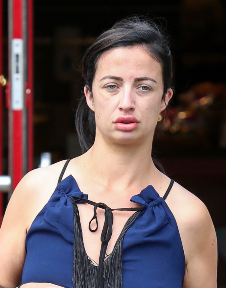  Painful procedure ... Chantelle pictured just after getting lips filled