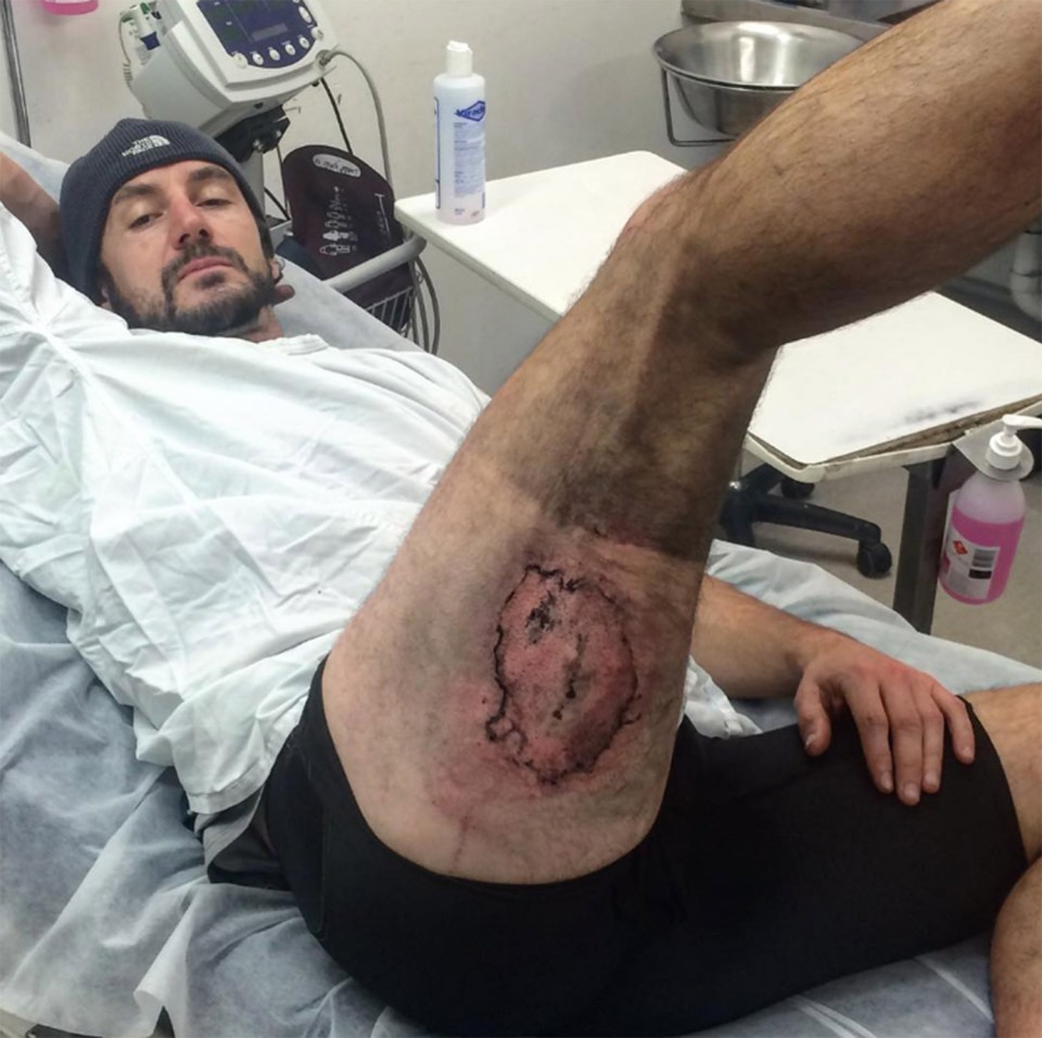  iDon't believe it... British mountain biker Gareth Clear shows his horror injuries he suffered after iPhone 6 exploded and melted through his shorts