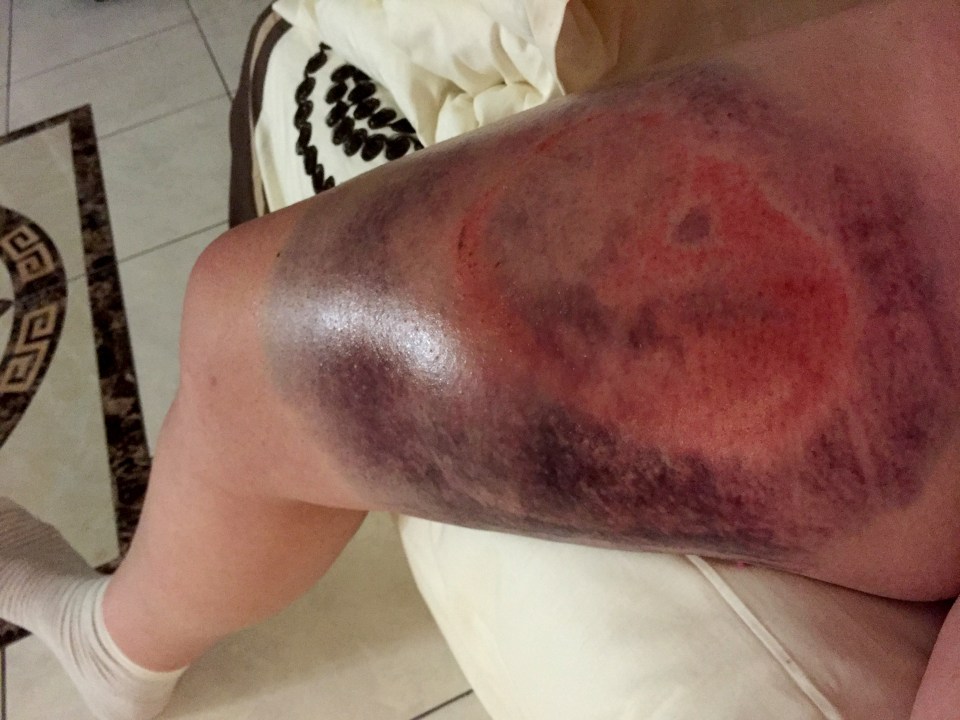 Antoinette Burger, 32, was left with painful bruises after her spooked horse kicked her in the leg