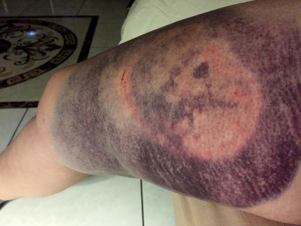 The injury, 48 hours after the incident, quickly became black, blue and red