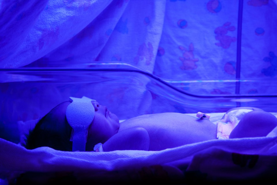 Six in 10 newborn babies develop jaundice