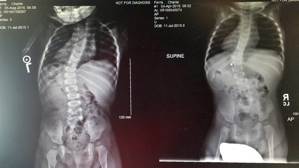 Xrays of Charlie's back in August and April 