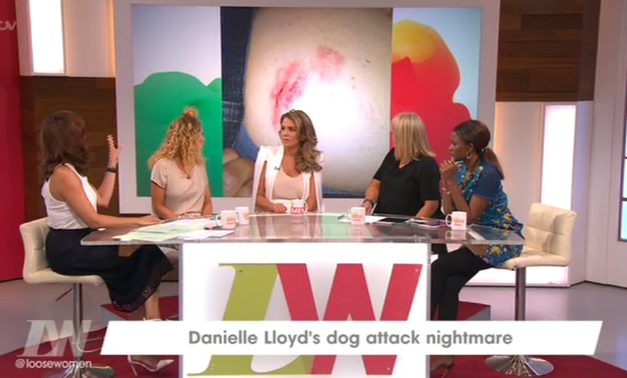 Just some of Michael's injuries were able to be shown on Loose Women 