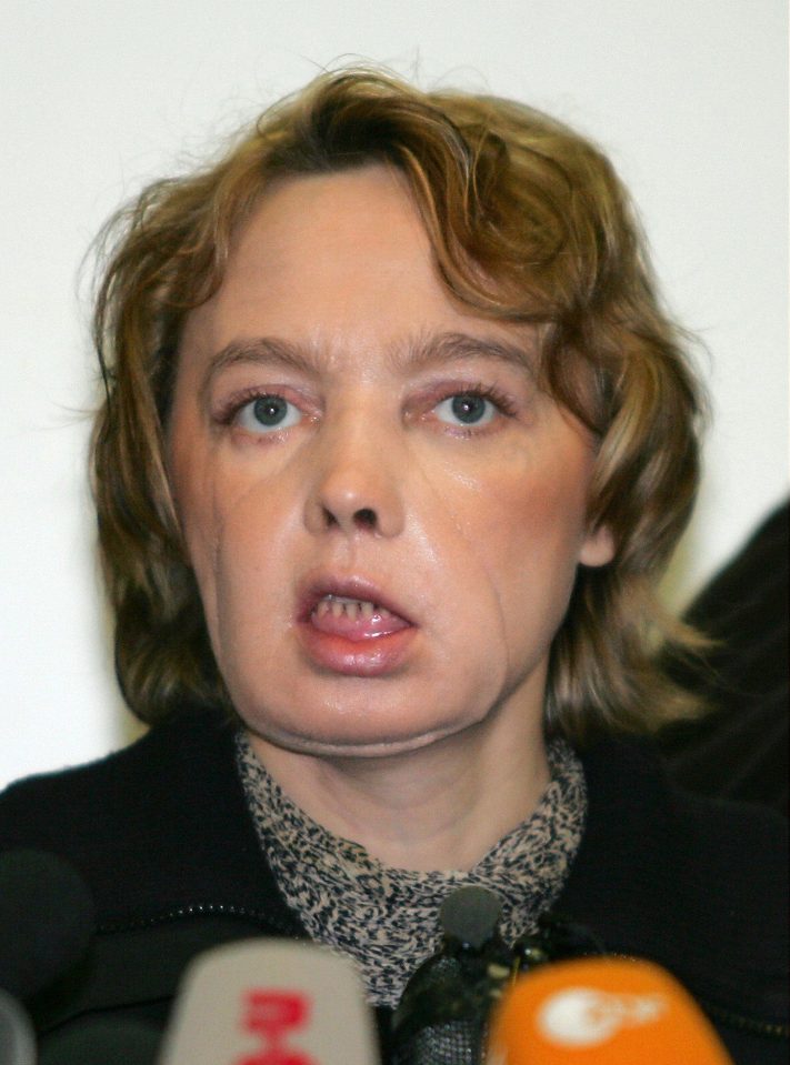 World's first face transplant patient Isabelle Dinoire a few months after her surgery