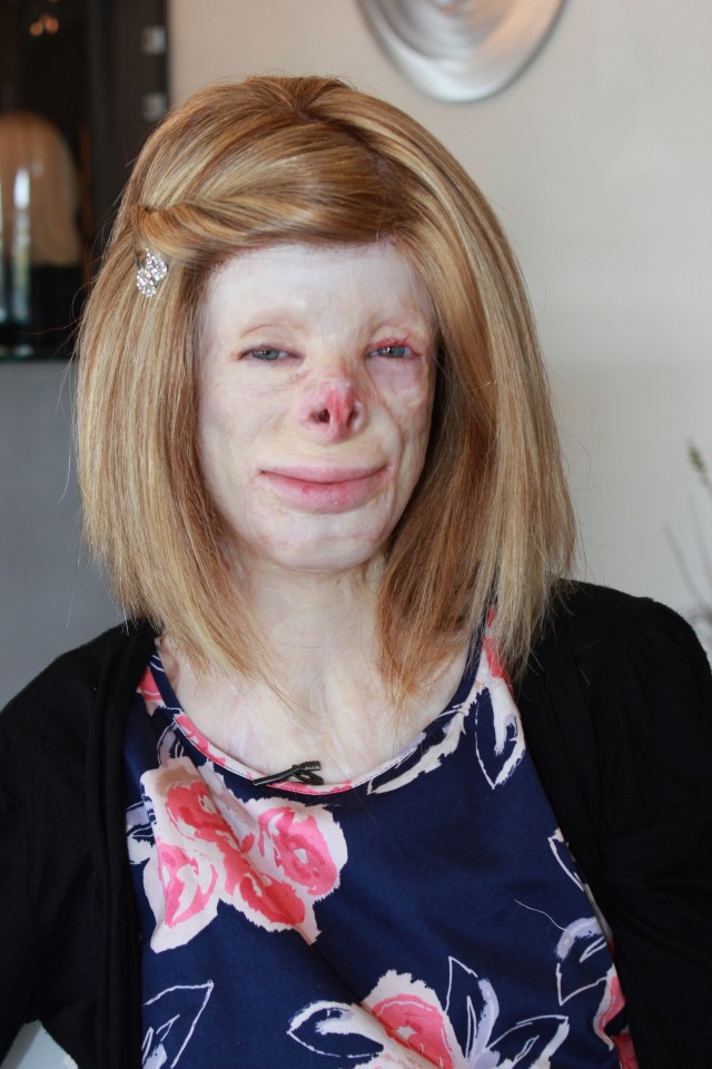 Terri Calvesbert who suffered 90% burns.