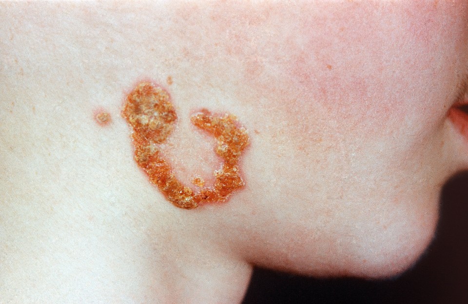 A child with impetigo 