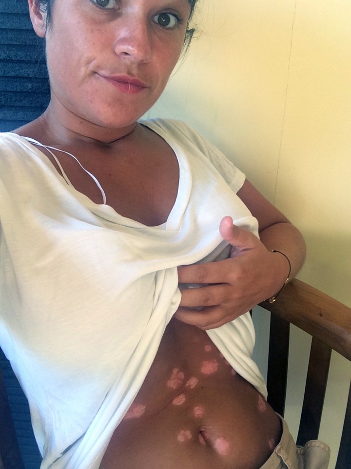 Brave psoriasis sufferer Lianne Hunter has said she will continue to wear her bikini with pride despite have the condition