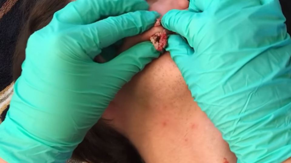 Removing a cyst on a boy's face