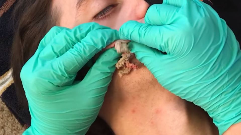 Removing a cyst on a boy's face