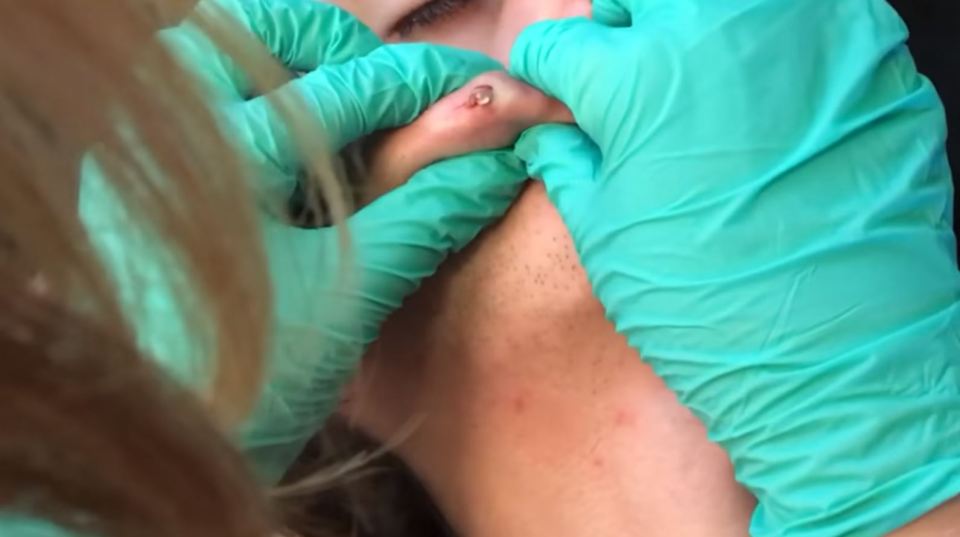 Removing a cyst on a boy's face