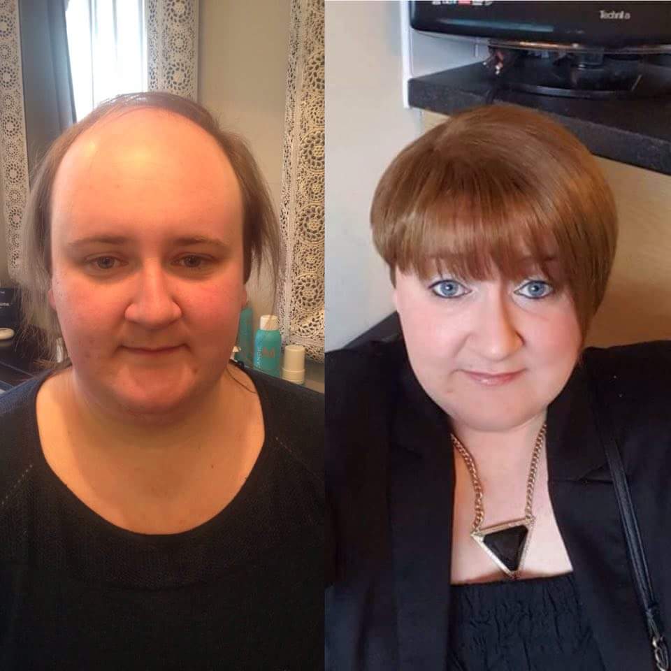  Nicola Hanratty, pictured before and after she started losing her hair