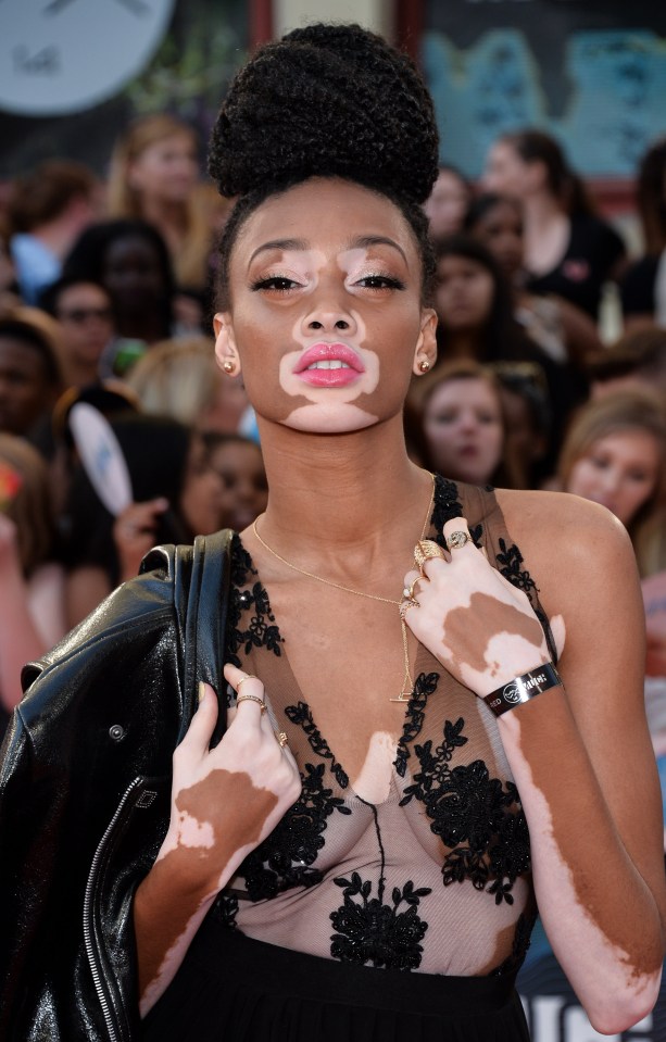 Winnie Harlow has spoken out about her experiences of living with the condition