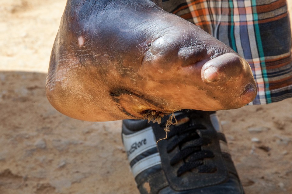  A man affected by leprosy shows an open wound on the sole of his foot