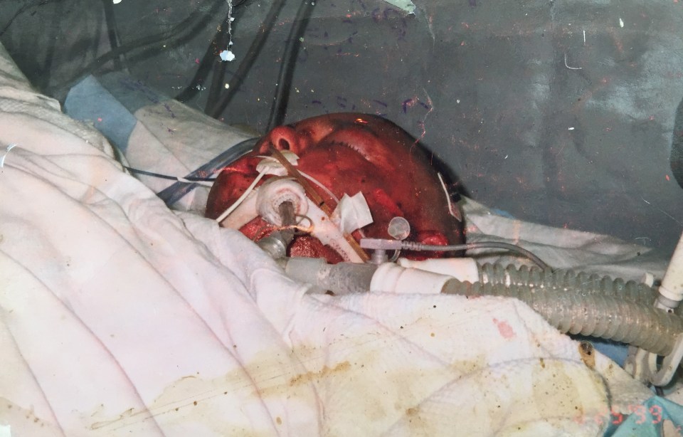  Piper was severely burned. Pictured in hospital, August 1999