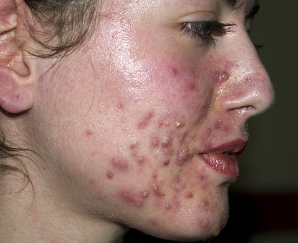 A teen suffering with acne 