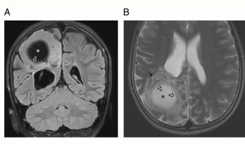  A 12-year-old boy complaining of headaches and projectile vomiting for six months was found to have a giant parasitic cyst containing tapeworm eggs buried in his brain