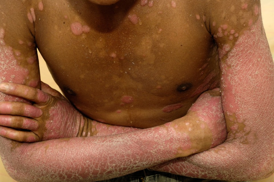 A patient with vitiligo 