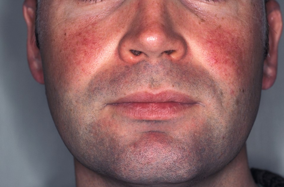 Rosacea can be triggered by alcohol or stress 