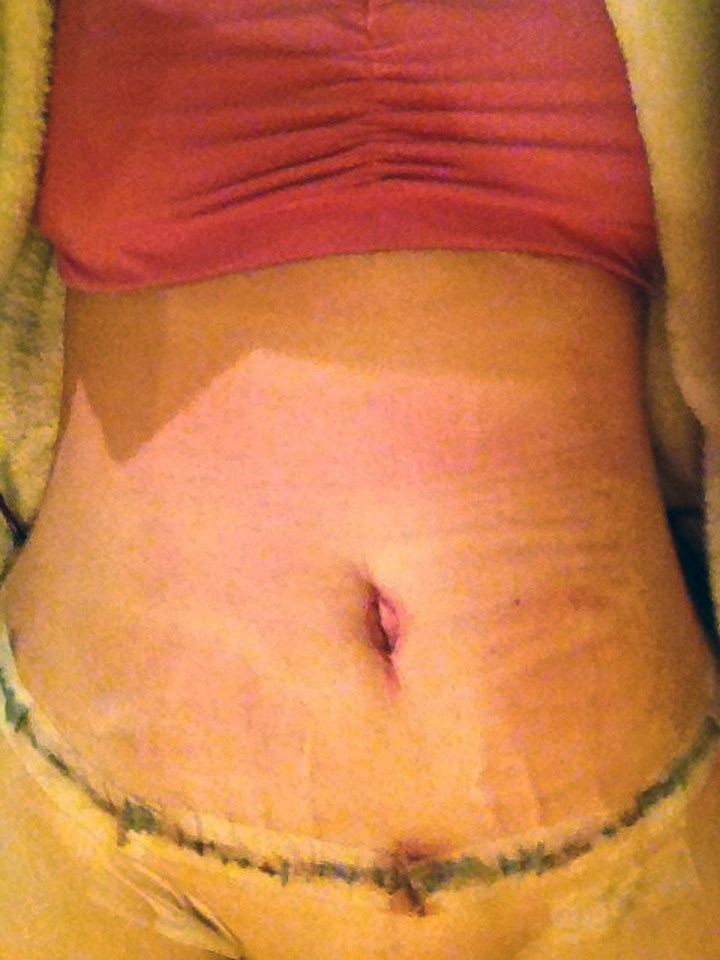 Britney's scar post tummy tuck