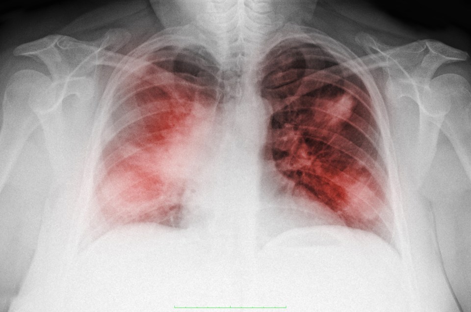  Most often the cause of sepsis is an infection we all recognise – pneumonia (illustrated in the X-ray above), urinary infections (UTIs), skin infections including cellulitis and infections in the stomach, appendicitis, for example