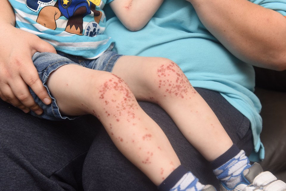 The 22-year-old said her three-year-old son broke out in painful red blisters after using the wipes