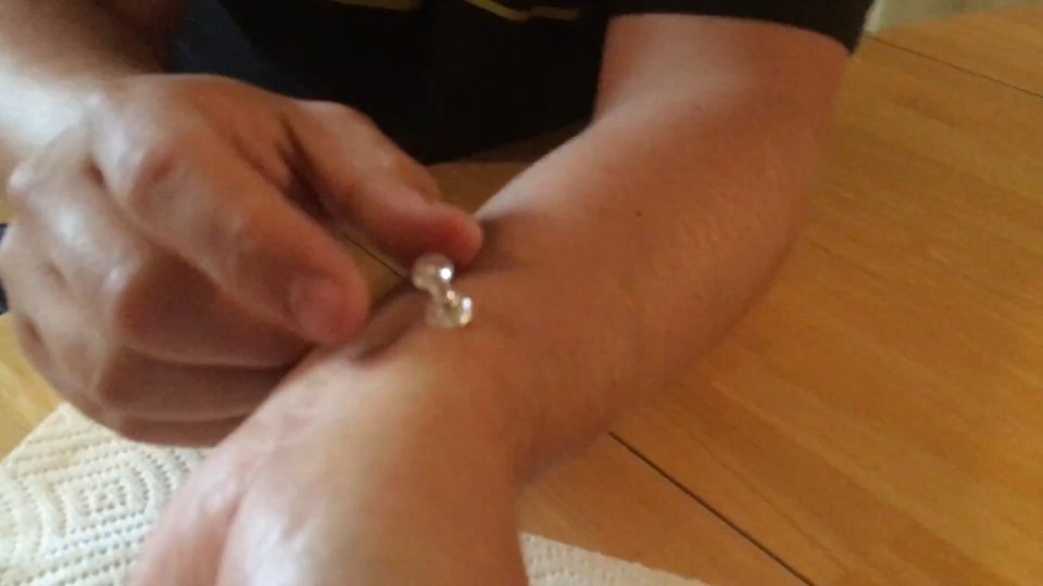 popping a cyst with a drawing pin