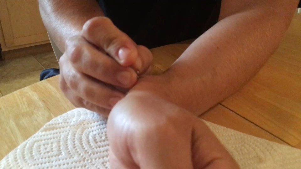 popping a cyst with a drawing pin